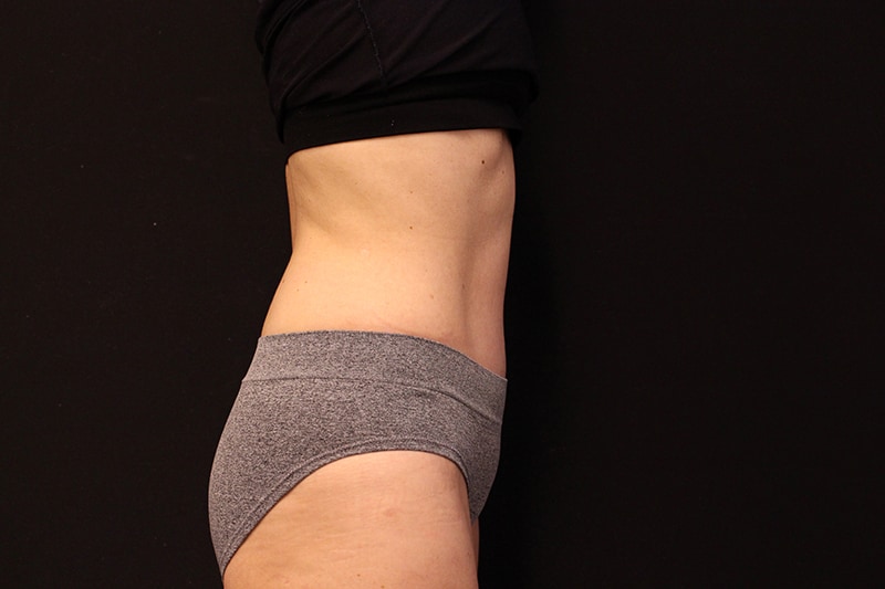 Tummy Tuck Before & After Image