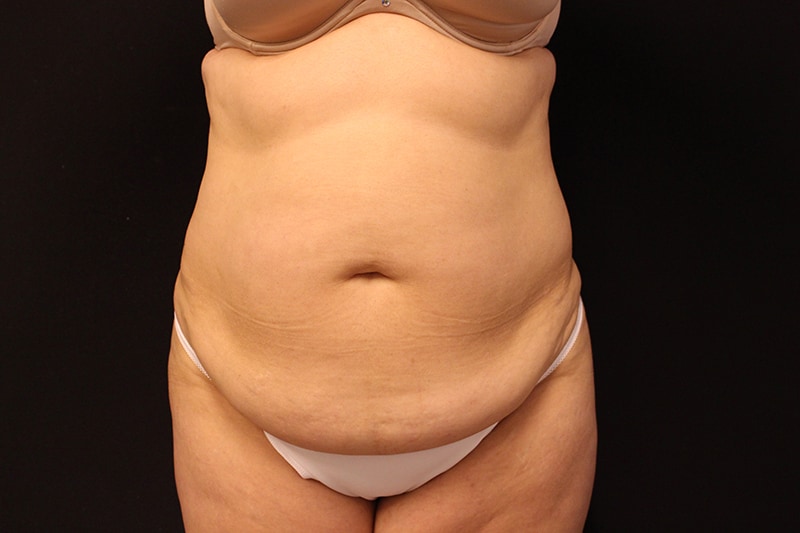 Tummy Tuck Before & After Image