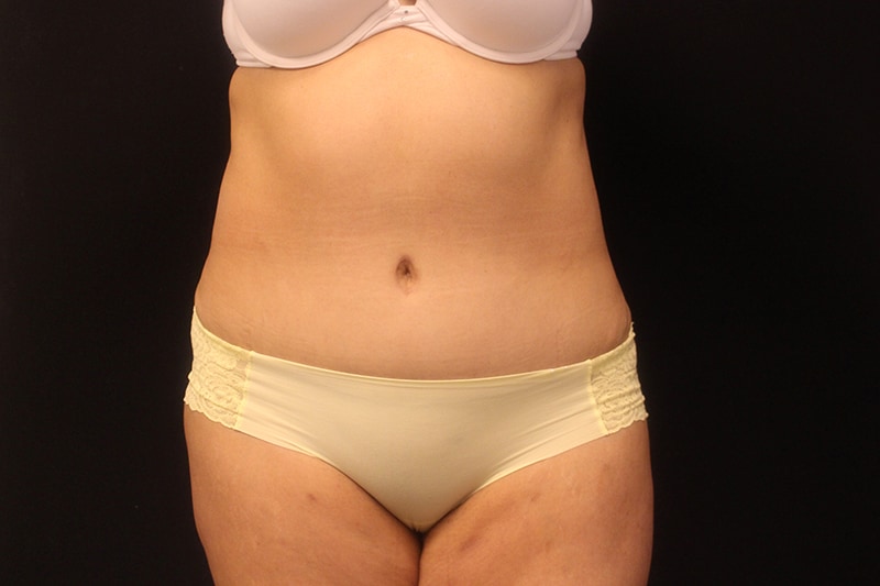Tummy Tuck Before & After Image