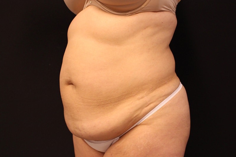 Tummy Tuck Before & After Image