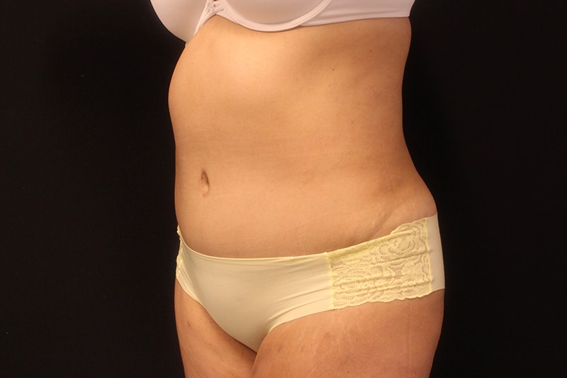 Tummy Tuck Before & After Image