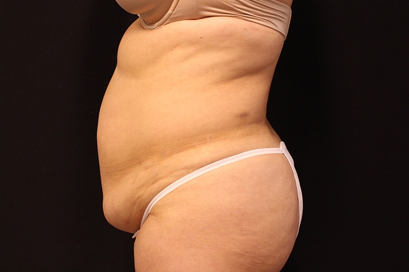 Tummy Tuck Before & After Image