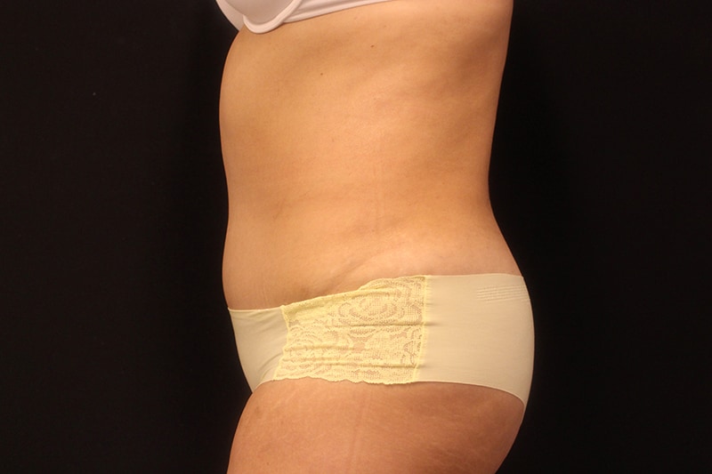 Tummy Tuck Before & After Image