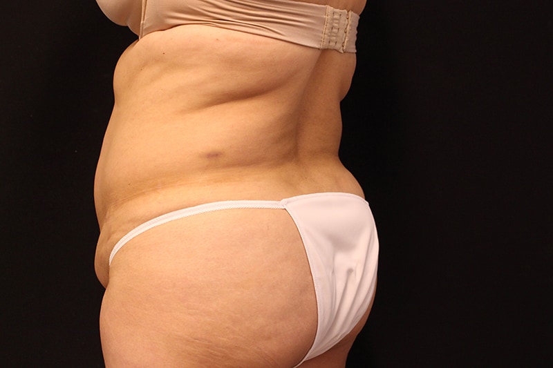 Tummy Tuck Before & After Image