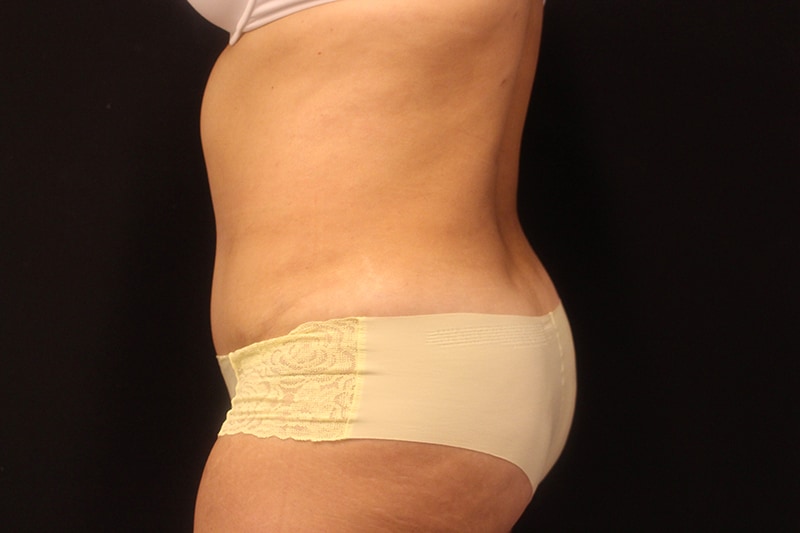 Tummy Tuck Before & After Image
