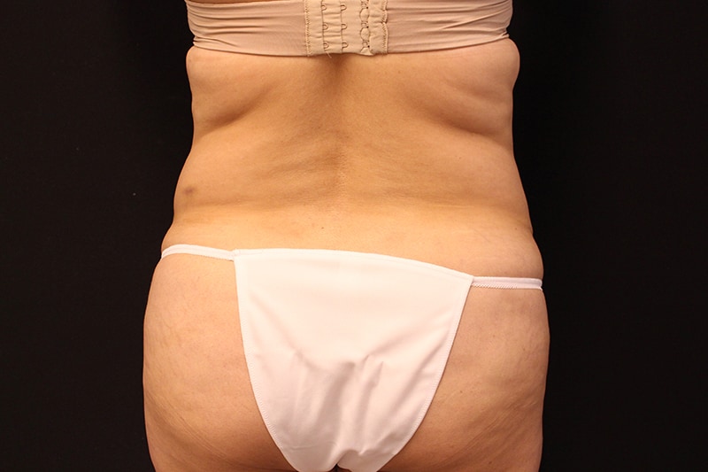 Tummy Tuck Before & After Image