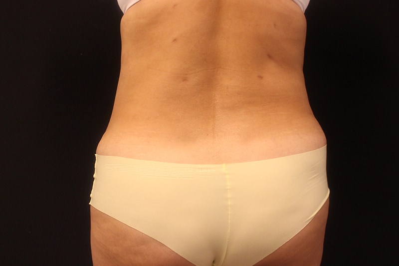 Tummy Tuck Before & After Image