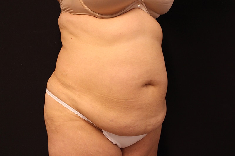 Tummy Tuck Before & After Image