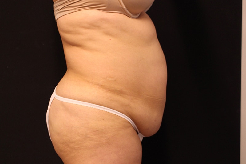 Tummy Tuck Before & After Image