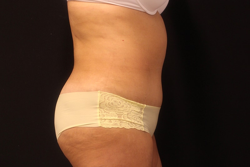 Tummy Tuck Before & After Image