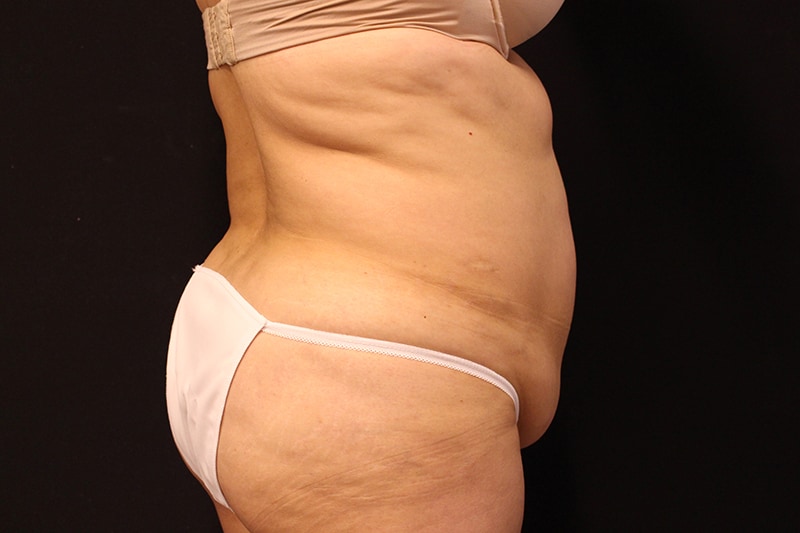 Tummy Tuck Before & After Image