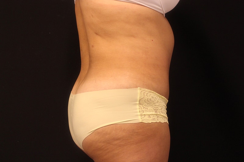 Tummy Tuck Before & After Image