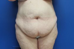 Tummy Tuck Before & After Image