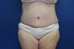 Tummy Tuck Before & After Image