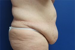 Tummy Tuck Before & After Image