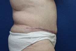 Tummy Tuck Before & After Image