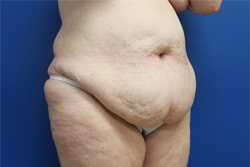 Tummy Tuck Before & After Image