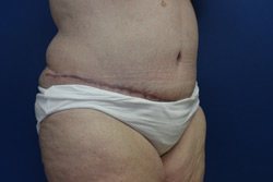 Tummy Tuck Before & After Image