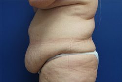Tummy Tuck Before & After Image