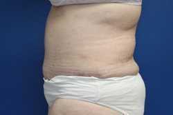 Tummy Tuck Before & After Image