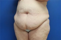 Tummy Tuck Before & After Image