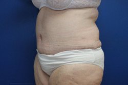 Tummy Tuck Before & After Image
