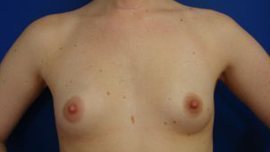 Breast Augmentation Before & After Image
