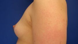 Breast Augmentation Before & After Image