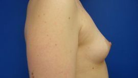 Breast Augmentation Before & After Image
