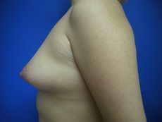 Breast Augmentation Before & After Image