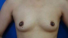 Breast Augmentation Before & After Image