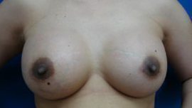 Breast Augmentation Before & After Image