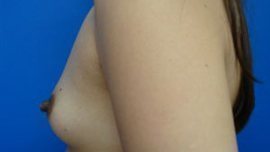 Breast Augmentation Before & After Image