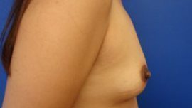 Breast Augmentation Before & After Image