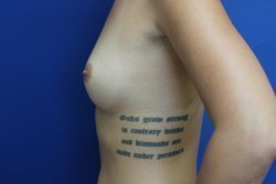 Breast Augmentation Before & After Image