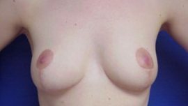 Breast Reduction Before & After Image