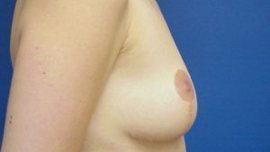 Breast Reduction Before & After Image