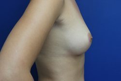 Gummy Bear Breast Implants Before & After Image