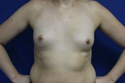 Gummy Bear Breast Implants Before & After Image