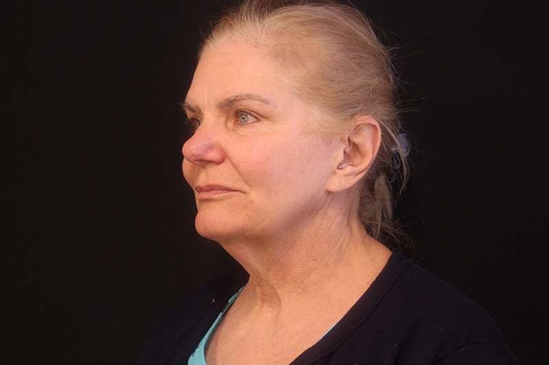 Facelift Before & After Image