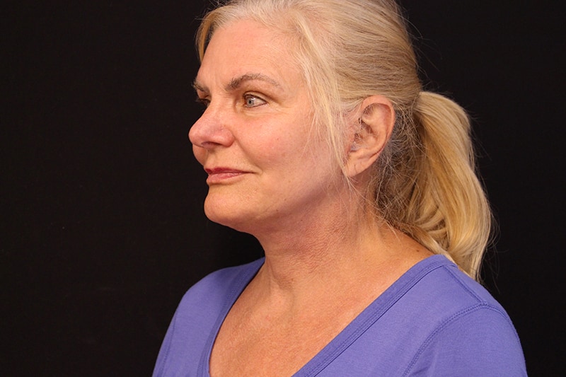 Facelift Before & After Image