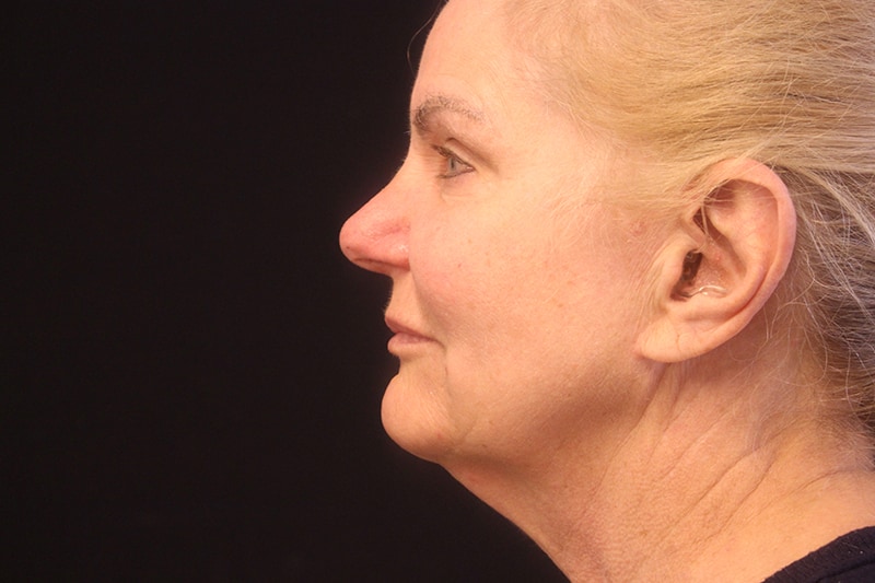Facelift Before & After Image