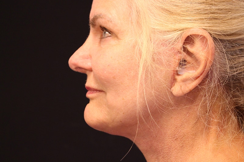 Facelift Before & After Image