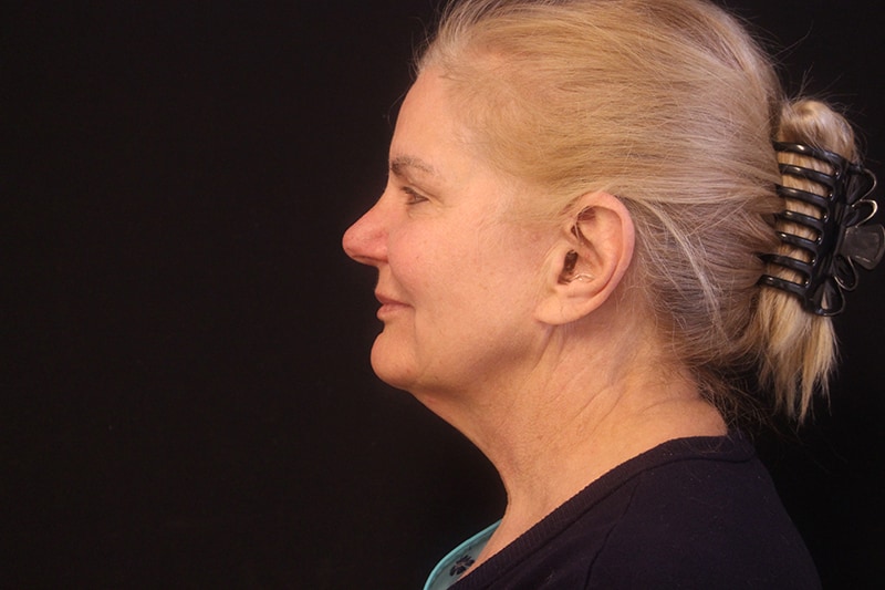 Facelift Before & After Image