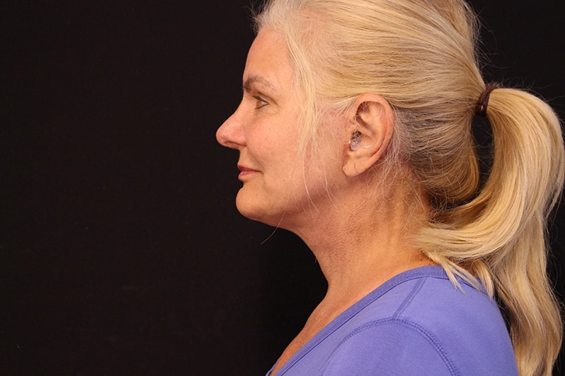 Facelift Before & After Image