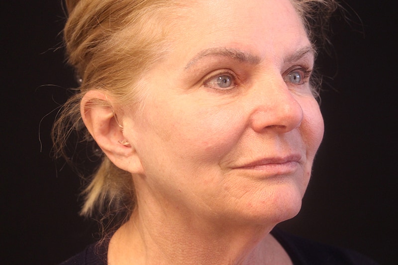 Facelift Before & After Image