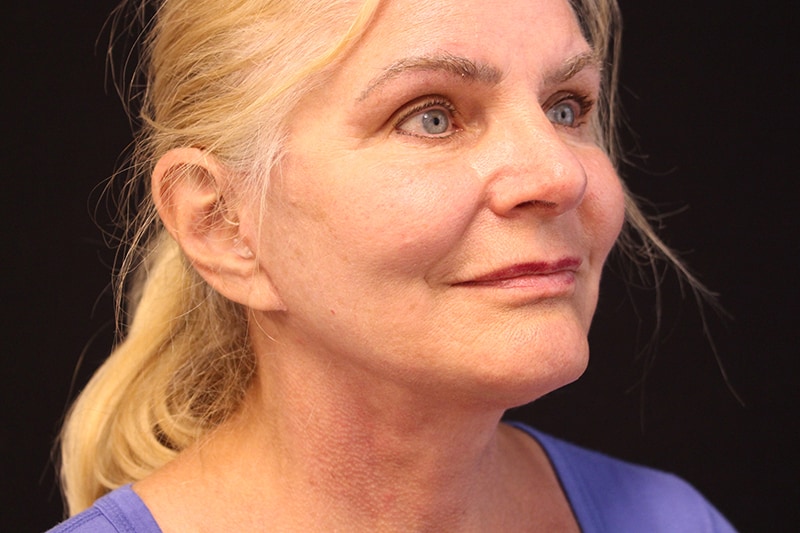 Facelift Before & After Image