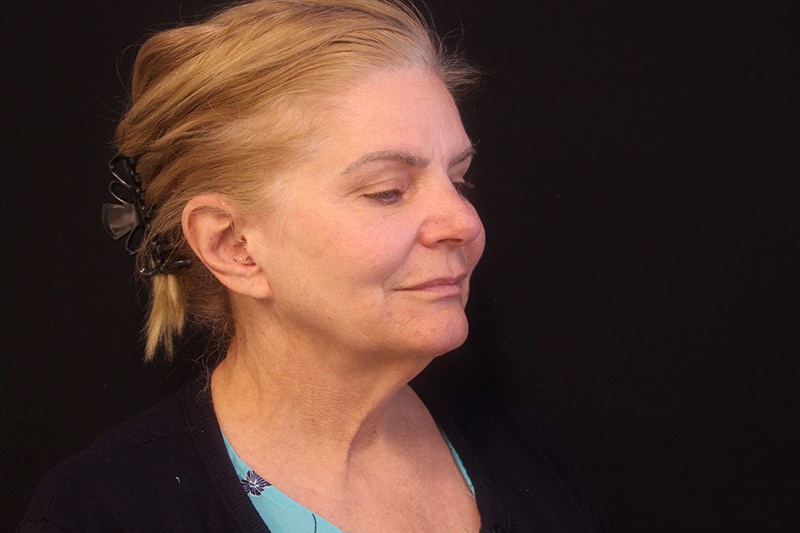 Facelift Before & After Image
