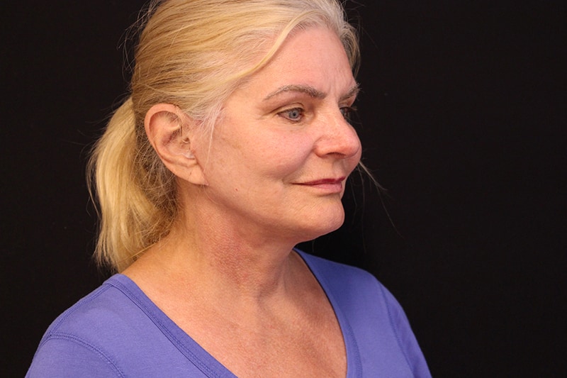 Facelift Before & After Image