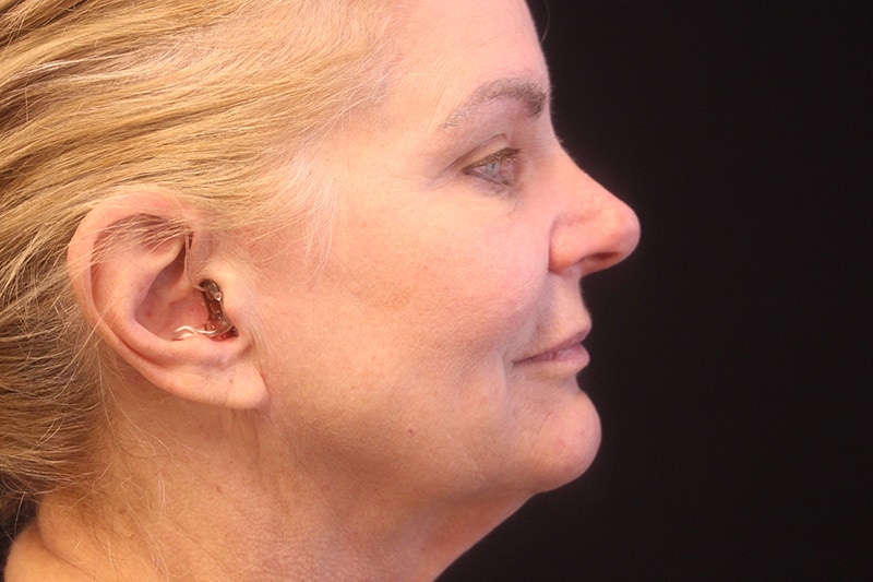 Facelift Before & After Image